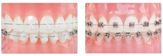 https://iortho.hk/en/wp-content/uploads/2020/02/Aesthetic-Self-ligating-Braces-20250319.webp