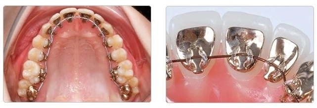 https://iortho.hk/en/wp-content/uploads/2020/02/Lingual-Invisible-Braces-20250319.webp