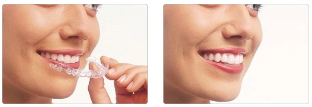 https://iortho.hk/en/wp-content/uploads/2020/02/Removable-Clear-Aligner-20250319.webp