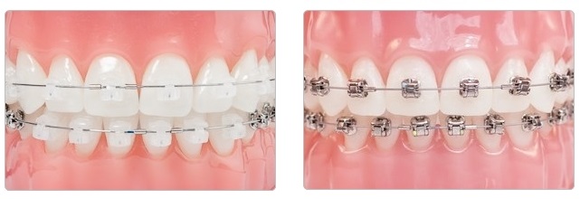 Aesthetic Self-ligating Braces